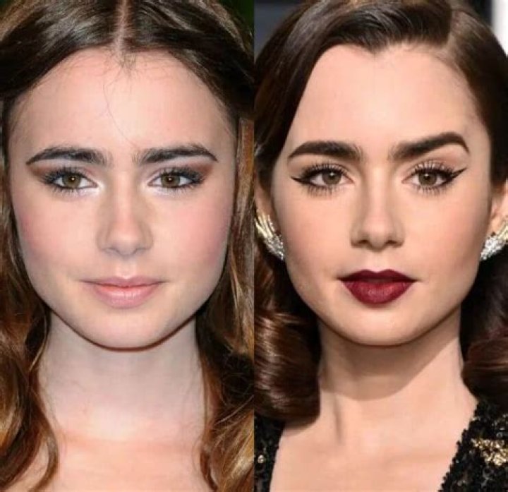 Actress Lily Collins Botox And Lip Filler With Her Before Ad After Photos