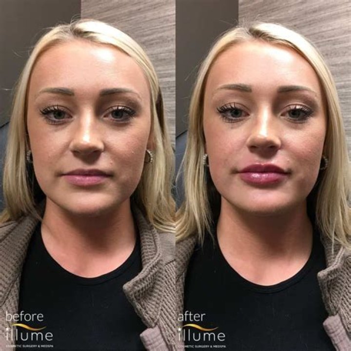 Beth Dutton Lip Injections: Surgery Before And After Photos