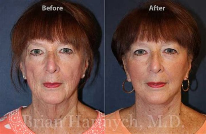 Has Lil Wayne Done Face Lift Surgery?