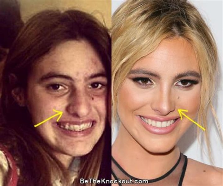 Lele Pons Nose Transformation: Get to Know Everything from Our Side!